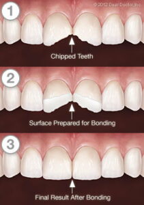cosmetic tooth bonding before and after