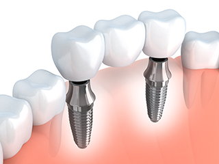 multiple dental implant implementations