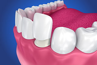dental veneers implementation process