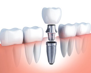 single dental implant implementations