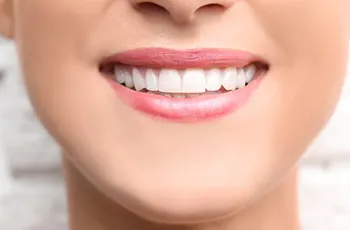 Cosmetic-Tooth-Bonding-img