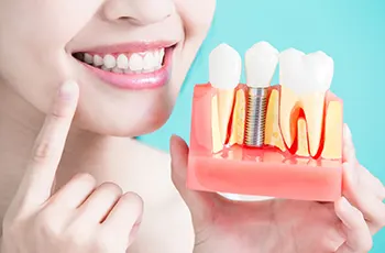 Dental-implants-img