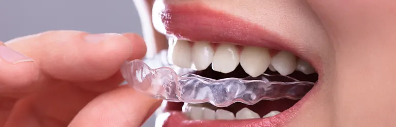 Clear Aligners for Adults